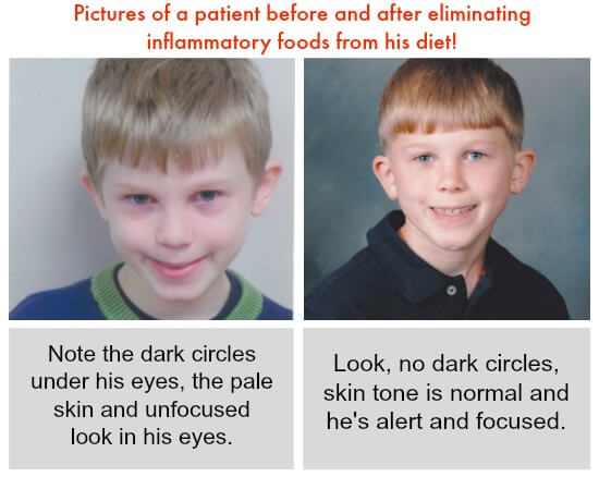 Pictures of a patient before and after eliminating inflammatory foods from his diet!