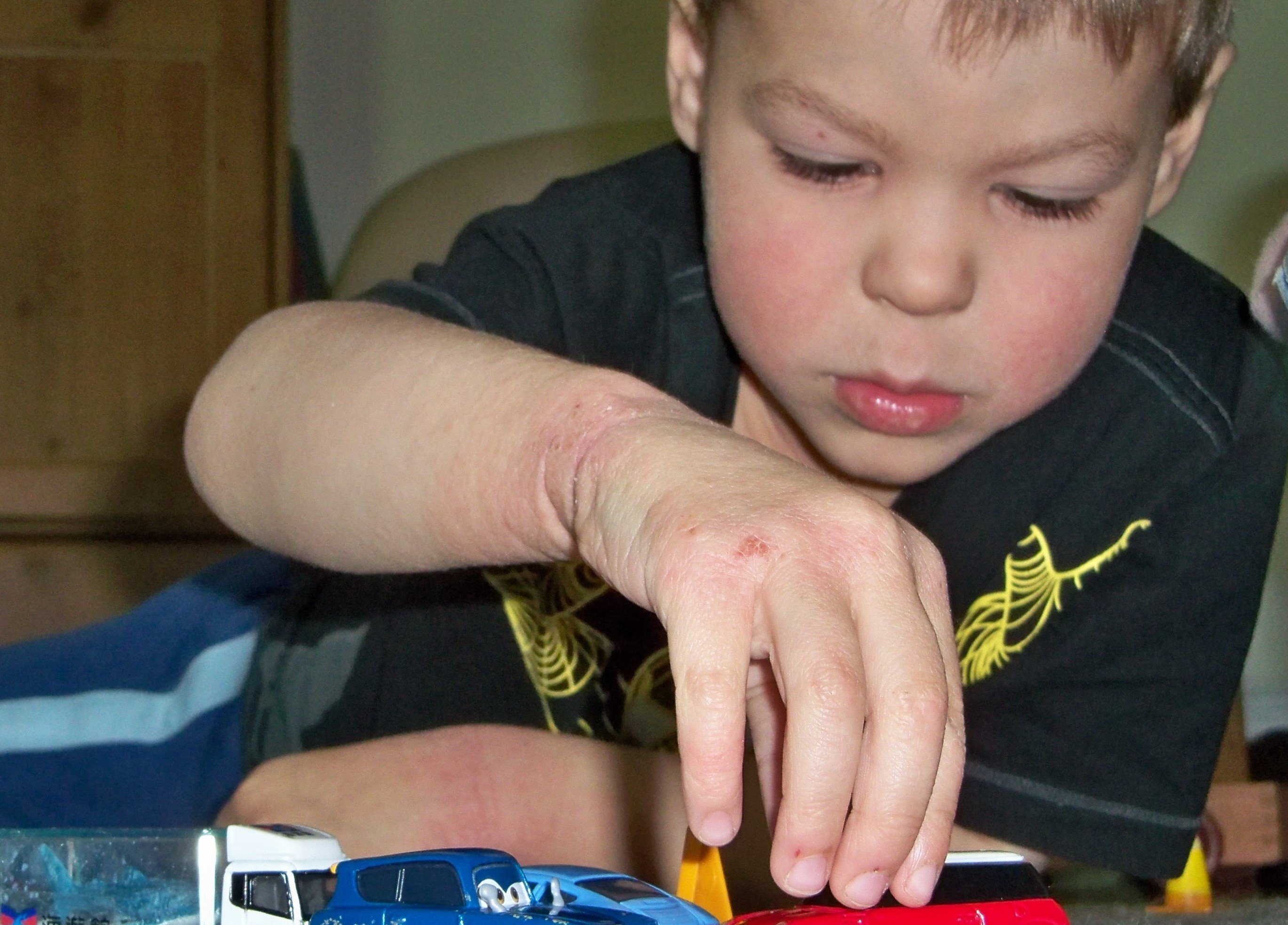 Jennifer Roberg's son with eczema